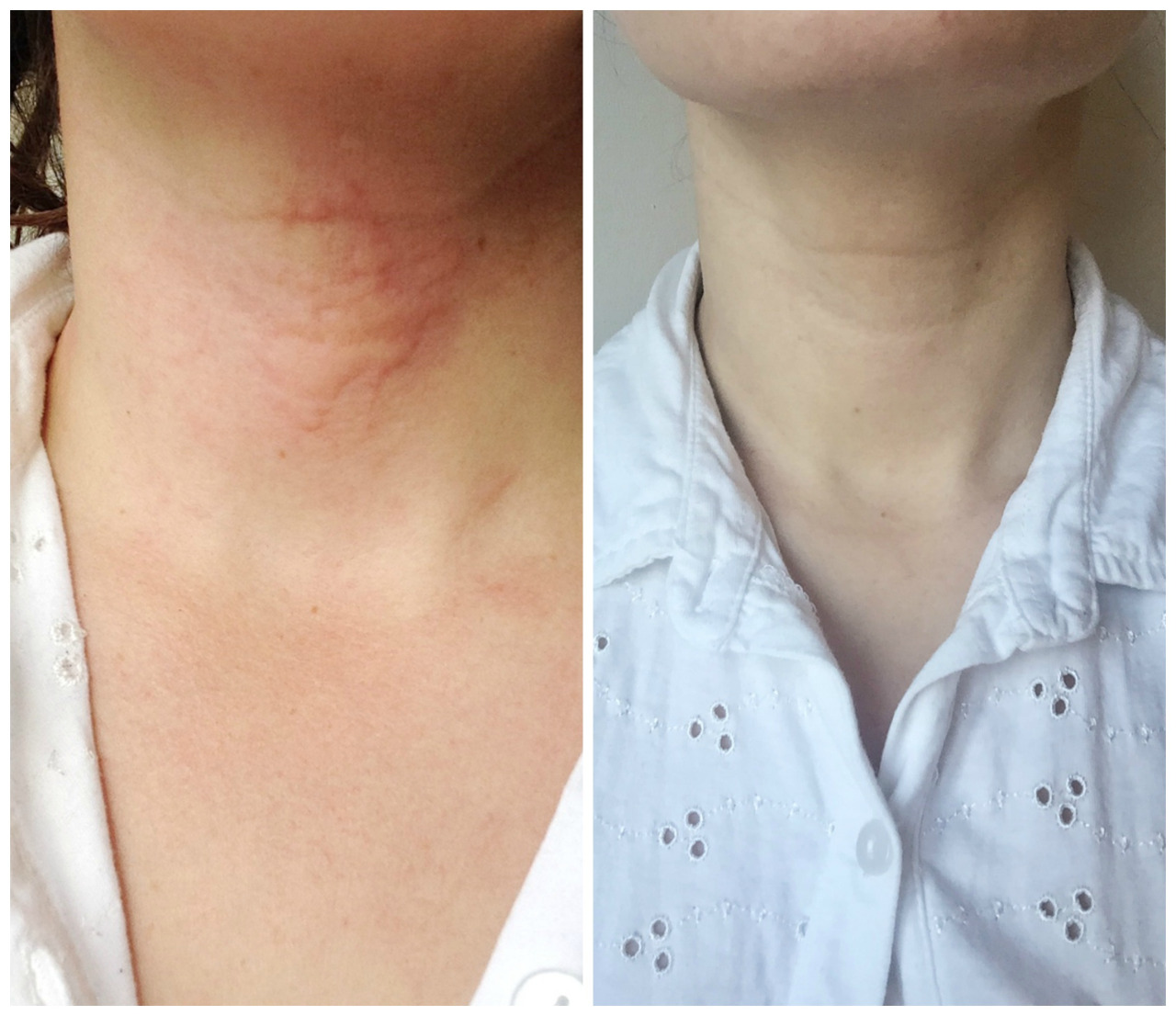 Дермаспрей Интензив от Salcura успокоява сухата и раздразнена кожа, овлажнява в дълбочина и се бори с псориазис, дерматит, атопична кожа, екзема чрез натурални съставки.