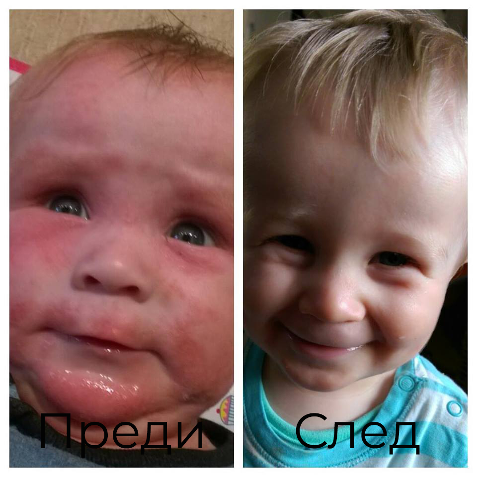 Bioskin Junior душгел срещу псориазис облекчава състоянието на кожата, хидратира я и помага да се намали рекацията при дерматит, екзема, атопична кожа.