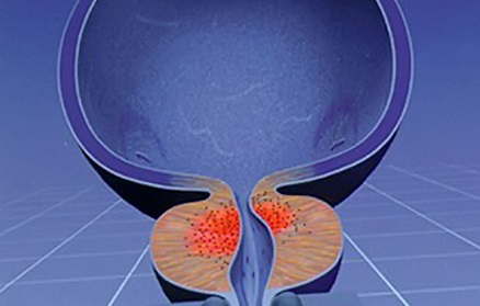 ULTIMATE Prostate Support 410 мг 60 гел-капсули от Natural Factors на чудесна цена подобрява състоянието на простатата