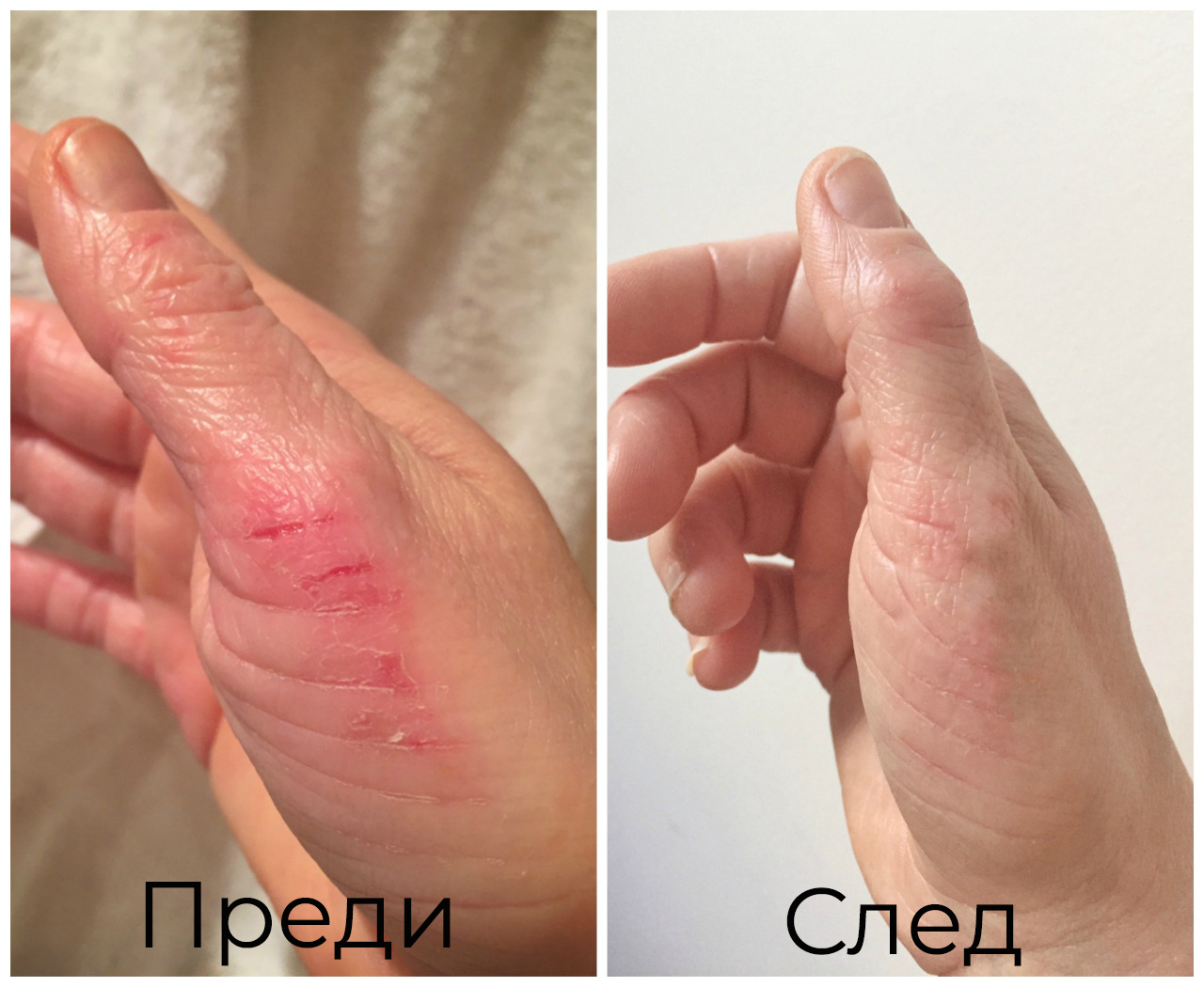 Bioskin Dermaserum срещу суха, дефидратирана кожа, дерматит, псоризис, екзема.