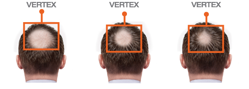 Minoxidil 5% Hair Regrowth Treatment For Men 3x60 мл на топ цена от Foligain е изключително ефективно средство за справяне с косопад.